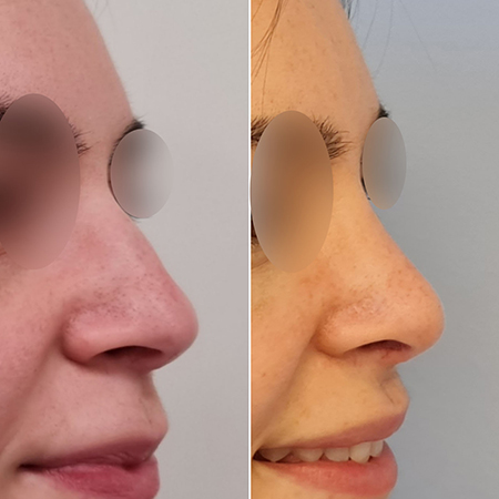 Indicaciones para tratar peque&ntilde;as imperfecciones nasales | Diferencias entre rinoplastia y rinomodelacion